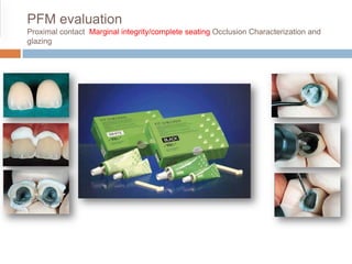 PFM evaluation
Proximal contact Marginal integrity/complete seating Occlusion Characterization and
glazing
 