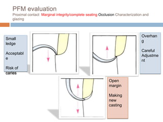 PFM evaluation
   Proximal contact Marginal integrity/complete seating Occlusion Characterization and
   glazing



                                                                                 Overhan
Small
                                                                                 g
ledge
                                                                                 Careful
Acceptabl
                                                                                 Adjustme
e
                                                                                 nt
Risk of
caries
                                                             Open
                                                             margin

                                                             Making
                                                             new
                                                             casting
 