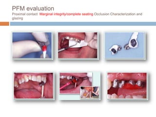 PFM evaluation
Proximal contact Marginal integrity/complete seating Occlusion Characterization and
glazing
 