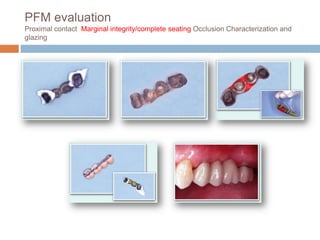 PFM evaluation
Proximal contact Marginal integrity/complete seating Occlusion Characterization and
glazing
 