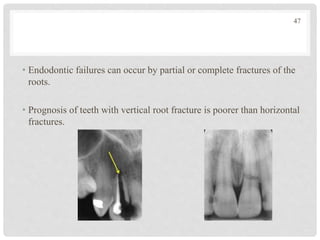 • Endodontic failures can occur by partial or complete fractures of the
roots.
• Prognosis of teeth with vertical root fracture is poorer than horizontal
fractures.
47
 