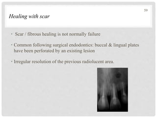 Healing with scar
• Scar / fibrous healing is not normally failure
• Common following surgical endodontics: buccal & lingual plates
have been perforated by an existing lesion
• Irregular resolution of the previous radiolucent area.
59
 