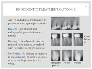 ENDODONTIC TREATMENT OUTCOME
• Aim of endodontic treatment is to
prevent or cure apical periodontitis
• Healed: Both clinical and
radiographic presentations are
normal
• Healing: It is a dynamic process,
reduced radiolucency combined
with normal clinical presentation
• Not healed: No change or increase
in radiolucency, clinical signs may
or may not be present or vice
versa.
4 year
follow
up
Immediate
post op
3 years 6 years
6
 