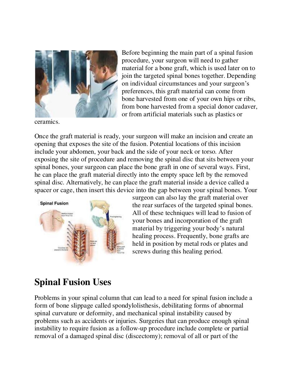 Success rates for Spinal Fusion Surgery Spinal Fusion