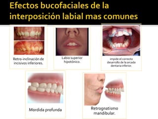 Retro-inclinación de
incisivos inferiores.
Labio superior
hipotónico.
impide el correcto
desarrollo de la arcada
dentaria inferior.
Mordida profunda Retrognatismo
mandibular.
 