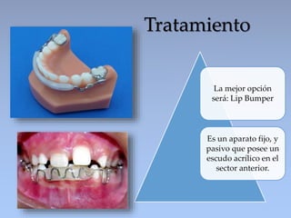 La mejor opción
será: Lip Bumper
Es un aparato fijo, y
pasivo que posee un
escudo acrílico en el
sector anterior.
Tratamiento
 
