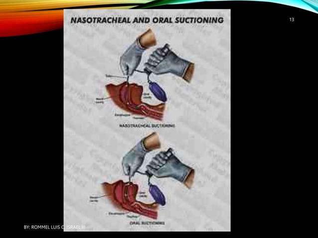 SUCTIONING OROPHARYNGEAL AND NASOPHARYNGEAL CAVITIES | PPTX