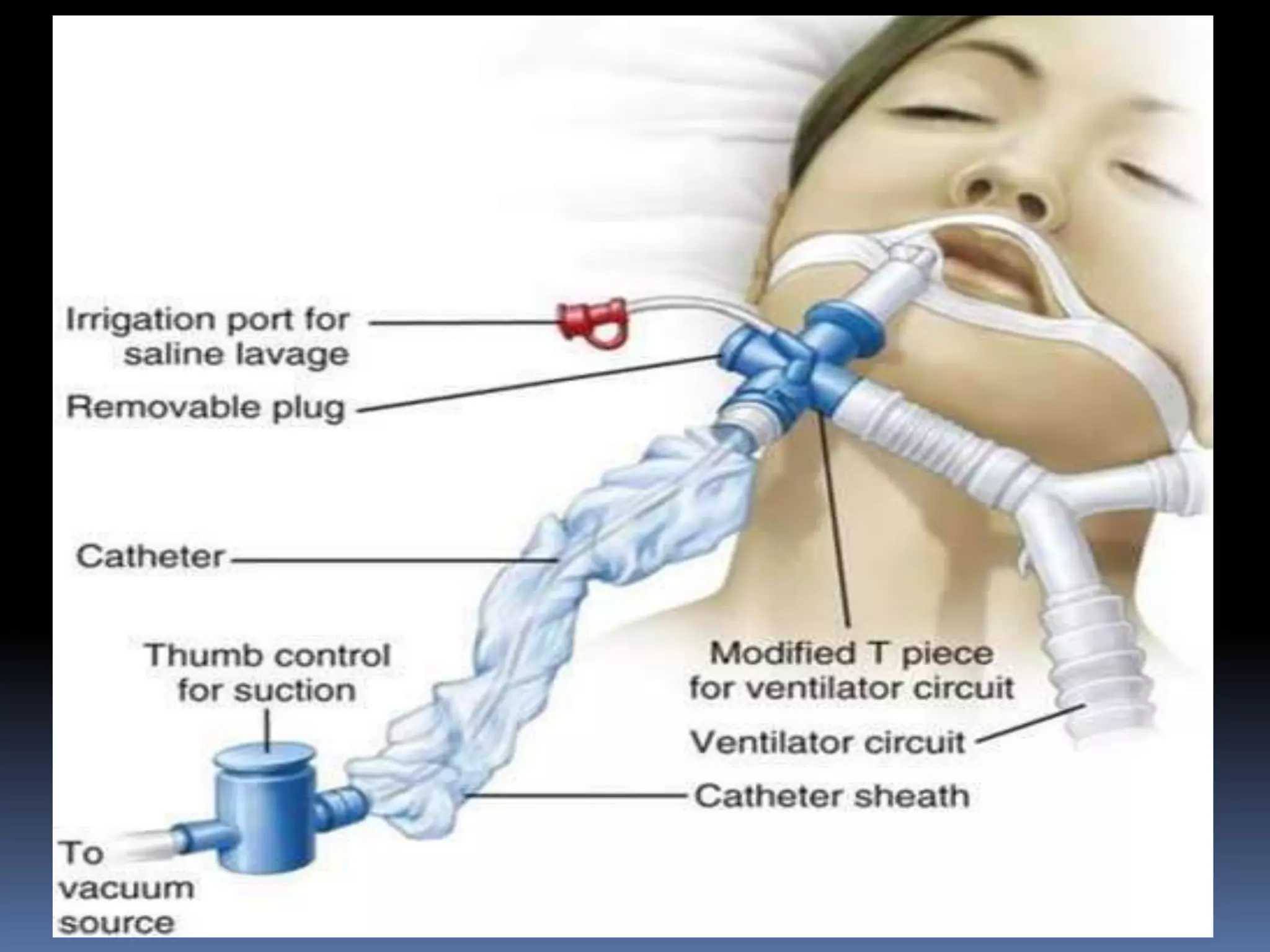 Suctioning Patients: Avoiding Critical Errors (Nurse Protocol) - rrk41tm