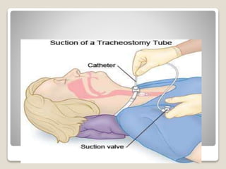 Hand Suction Method suctioning procedure ppt.pptx