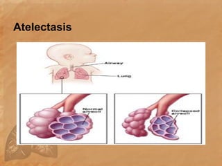 Atelectasis
 
