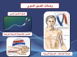 ‫الدموي‬ ‫الغسٌل‬ ‫وصالت‬
‫الناصور‬(‫الفستوال‬)‫الورٌدٌة‬ ‫الشرٌانٌة‬.
‫الصناعٌة‬ ‫الوصلة‬–‫الورٌدٌة‬ ‫الشرٌانٌة‬
‫الدموي‬ ‫الغسٌل‬ ‫قسطرة‬
 