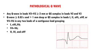 • Any Q-wave in leads V2–V3 ≥ 2 mm or QS complex in leads V2 and V3
• Q-wave ≥ 0.03 s and > 1 mm deep or QS complex in leads I, II, aVL, aVF, or
V4–V6 in any two leads of a contiguous lead grouping
• I, aVL,V6;
• V4–V6;
• II, III, and aVF
PATHOLOGICAL Q WAVE
 