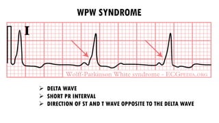 Ø DELTA WAVE
Ø SHORT PR INTERVAL
Ø DIRECTION OF ST AND T WAVE OPPOSITE TO THE DELTA WAVE
WPW SYNDROME
 