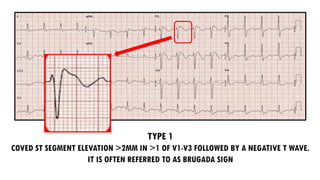 TYPE 1
COVED ST SEGMENT ELEVATION >2MM IN >1 OF V1-V3 FOLLOWED BY A NEGATIVE T WAVE.
IT IS OFTEN REFERRED TO AS BRUGADA SIGN
 