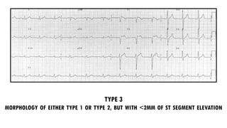 TYPE 3
MORPHOLOGY OF EITHER TYPE 1 OR TYPE 2, BUT WITH <2MM OF ST SEGMENT ELEVATION
 