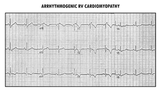 ARRHYTHMOGENIC RV CARDIOMYOPATHY
 
