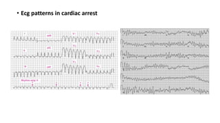 • Ecg patterns in cardiac arrest
 
