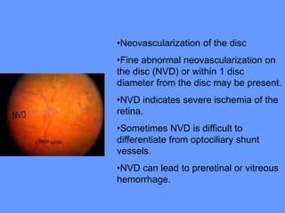 Nvd Optometry Sudden loss of vision IN A PATIENT ACUTELY | PPT