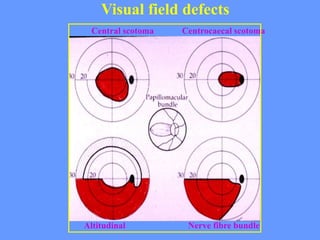 Sudden loss of vision IN A PATIENT ACUTELY | PPT