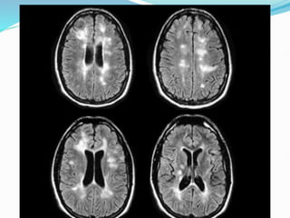 Sudden Loss of Vision Differential Diagnosis | PPTX