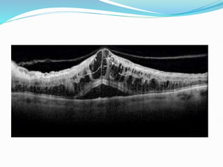 Sudden Loss of Vision Differential Diagnosis | PPTX