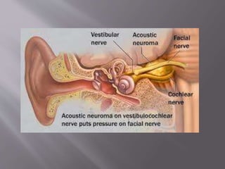 Sudden Sensorineural Hearing Loss | PPTX