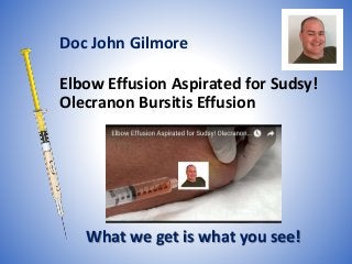 Elbow Effusion Aspirated for Sudsy!
Olecranon Bursitis Effusion
What we get is what you see!
Doc John Gilmore
 