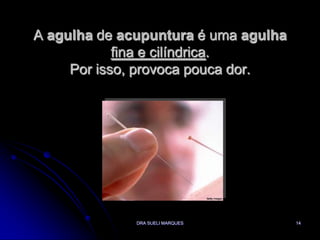 DRA SUELI MARQUES14A agulha de acupuntura é uma agulhafina e cilíndrica. Por isso, provoca pouca dor.