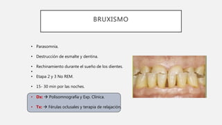 BRUXISMO
• Parasomnia.
• Destrucción de esmalte y dentina.
• Rechinamiento durante el sueño de los dientes.
•
• Etapa 2 y 3 No REM.
• 15- 30 min por las noches.
• Dx:  Polisomnografía y Exp. Clínica.
• Tx:  Férulas oclusales y terapia de relajación.
 