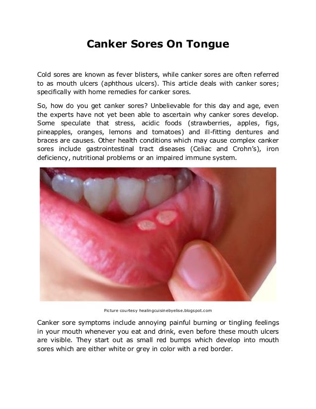 Suffering from canker sores on tongue