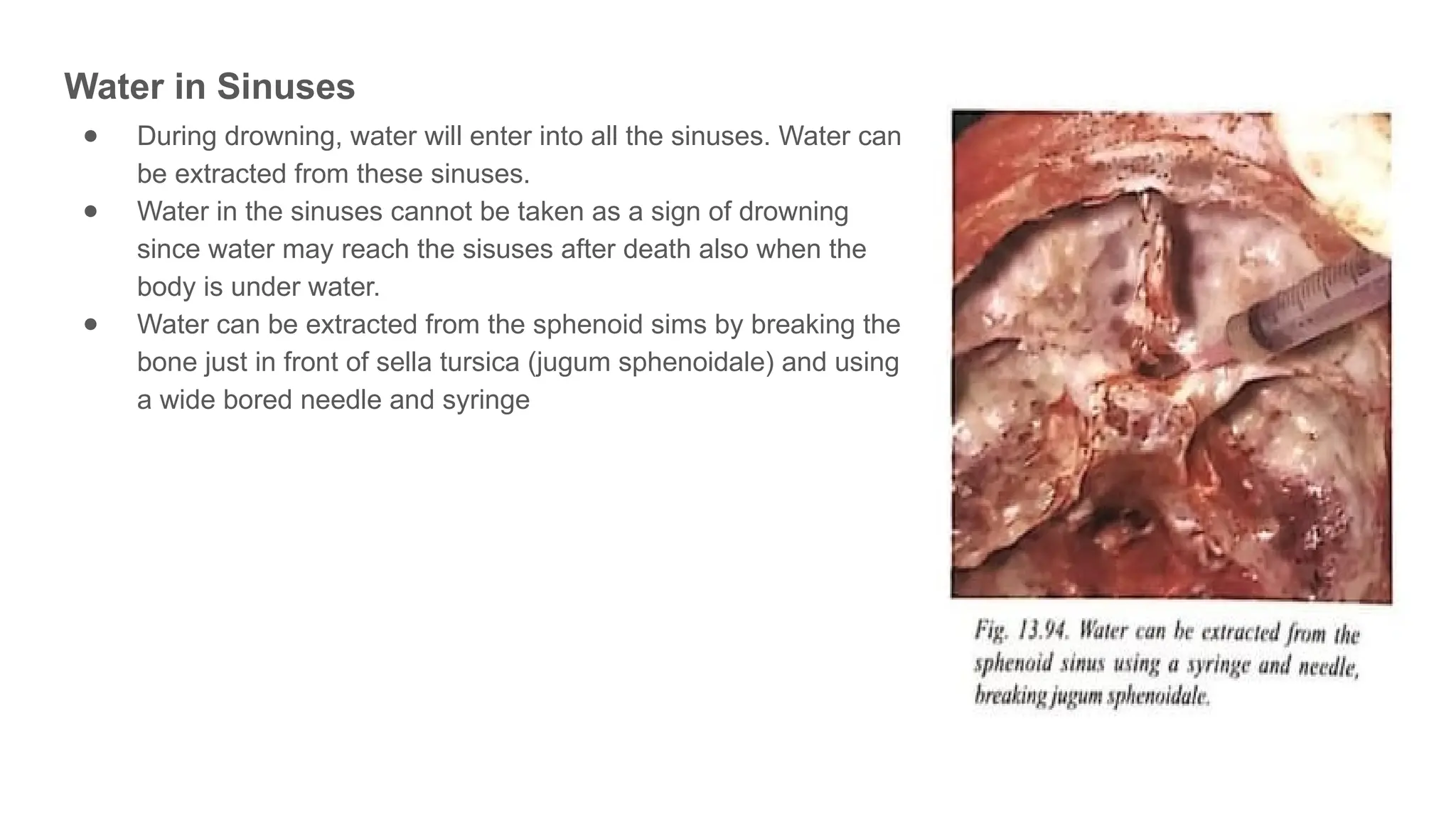 Water in Sinuses
● During drowning, water will enter into all the sinuses. Water can
be extracted from these sinuses.
● Water in the sinuses cannot be taken as a sign of drowning
since water may reach the sisuses after death also when the
body is under water.
● Water can be extracted from the sphenoid sims by breaking the
bone just in front of sella tursica (jugum sphenoidale) and using
a wide bored needle and syringe
 