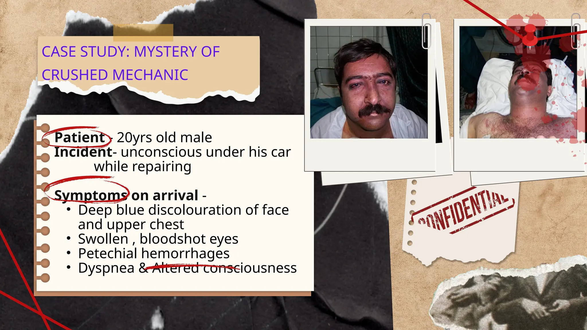 Patient - 20yrs old male
Incident- unconscious under his car
while repairing
Symptoms on arrival -
• Deep blue discolouration of face
and upper chest
• Swollen , bloodshot eyes
• Petechial hemorrhages
• Dyspnea & Altered consciousness
CASE STUDY: MYSTERY OF
CRUSHED MECHANIC
Sam
 