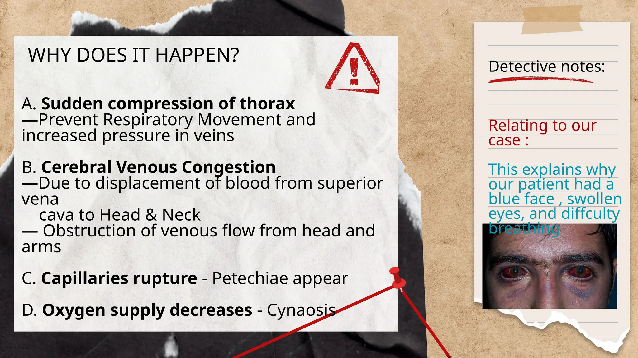 Detective notes:
WHY DOES IT HAPPEN?
A. Sudden compression of thorax
—Prevent Respiratory Movement and
increased pressure in veins
B. Cerebral Venous Congestion
—Due to displacement of blood from superior
vena
cava to Head & Neck
— Obstruction of venous flow from head and
arms
C. Capillaries rupture - Petechiae appear
D. Oxygen supply decreases - Cynaosis
Relating to our
case :
This explains why
our patient had a
blue face , swollen
eyes, and diffculty
breathing
m
 