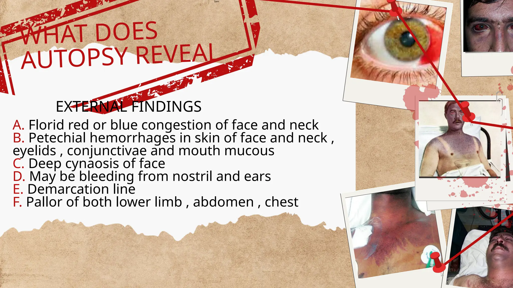 A. Florid red or blue congestion of face and neck
B. Petechial hemorrhages in skin of face and neck ,
eyelids , conjunctivae and mouth mucous
C. Deep cynaosis of face
D. May be bleeding from nostril and ears
E. Demarcation line
F. Pallor of both lower limb , abdomen , chest
WHAT DOES
AUTOPSY REVEAL
EXTERNAL FINDINGS
Sam
 