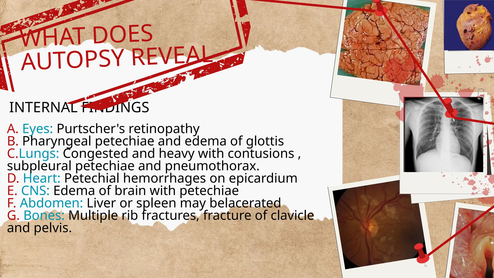 A. Eyes: Purtscher's retinopathy
B. Pharyngeal petechiae and edema of glottis
C.Lungs: Congested and heavy with contusions ,
subpleural petechiae and pneumothorax.
D. Heart: Petechial hemorrhages on epicardium
E. CNS: Edema of brain with petechiae
F. Abdomen: Liver or spleen may belacerated
G. Bones: Multiple rib fractures, fracture of clavicle
and pelvis.
INTERNAL FINDINGS
WHAT DOES
AUTOPSY REVEAL
SAM
 