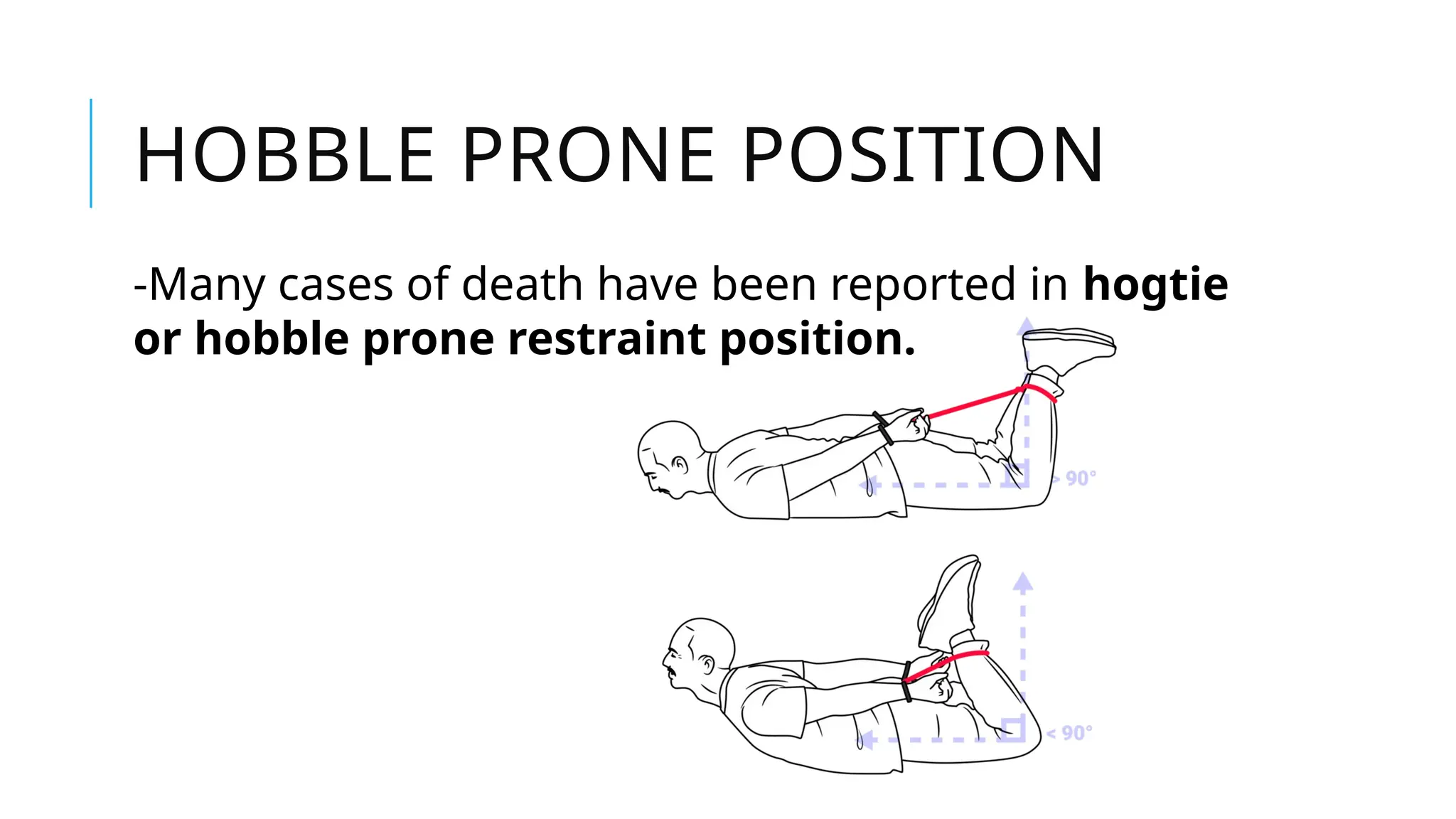 HOBBLE PRONE POSITION
-Many cases of death have been reported in hogtie
or hobble prone restraint position.
 