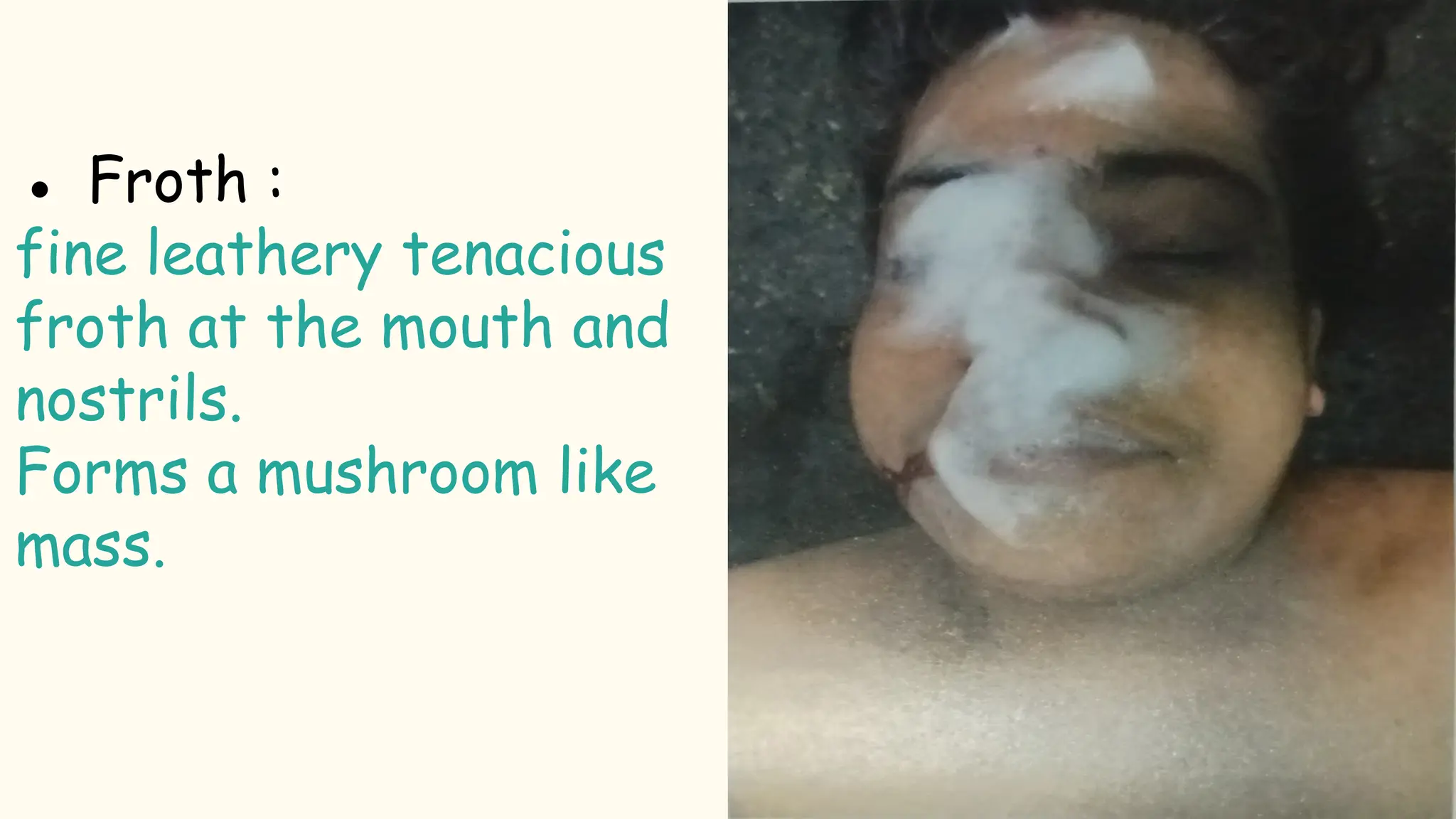 ● Froth :
fine leathery tenacious
froth at the mouth and
nostrils.
Forms a mushroom like
mass.
 