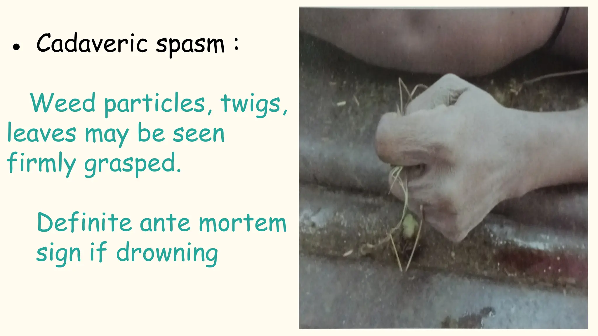 ● Cadaveric spasm :
Weed particles, twigs,
leaves may be seen
firmly grasped.
Definite ante mortem
sign if drowning
 