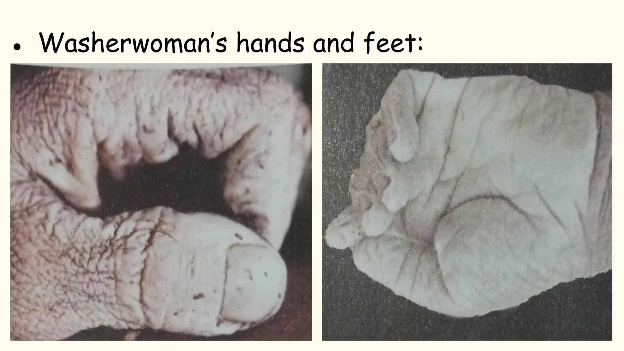 ● Washerwoman’s hands and feet:
 