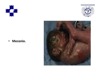 • Meconio.
 
