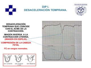 DIP I.
DESACELERACIÓN TEMPRANA.
DESACELERACIÓN
TEMPRANA QUE COINCIDE
CON EL ACME DE LA
CONTRACCIÓN.
IMAGEN INVERSA A LA
CONTRACCIÓN UTERINA.
(IMAGEN EN ESPEJO).
COMPRESIÓN DE LA CABEZA
FETAL
FC en rangos normales.
 