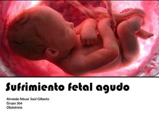 Sufrimiento fetal agudo
Almeida Návar Saúl Gilberto
Grupo 304
Obstetricia

 