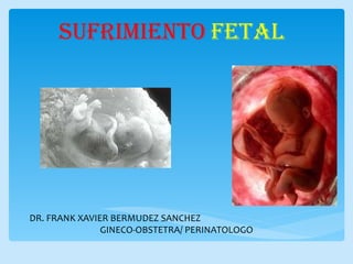 Sufrimiento fetal(fxbs)