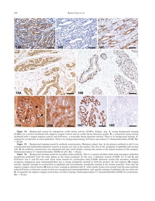 Figure 14. Background caused by endogenous avidin–biotin activity (EABA). Kidney, dog. A, strong background staining
(EABA) on a section incubated with negative reagent control and an avidin–biotin detection system. B, a consecutive tissue section
incubated with a reagent negative control and EnVision+, a nonavidin–biotin detection method. There is no background staining. C,
staining for cytokeratins in renal epithelium. There is no background staining. EnVision+ peroxidase-3,39-diaminobenzidine (DAB). Bar
5 60 mm.
Figure 15. Background staining caused by antibody concentration. Mammary gland, dog. A, the primary antibody to p63 is too
concentrated and immunohistochemical reaction is present not only in the nucleus, but also in the cytoplasm of epithelial and stromal
cells. B, the antibody concentration was optimized and only nuclei display staining (the nucleus is the typical location of this antigen).
Immunoperoxidase-3,39-diaminobenzidine (DAB) for p63. Bar 5 60 mm.
Figure 16. Background staining caused by secondary (link) antibody. This is a common problem when using secondary antibodies
recognizing antibodies from the same species as the tissue examined. In this case, 2 detection systems (LSAB+ for A and B) and
EnVision+ (for C and D) were used. Goat tissue stained for cytokeratins using LSAB+ detection system (the secondary antibody
recognizes endogenous goat immunoglobulins) has a strong nonspecific staining in both the positive (A) and negative (B) reagent
sections. Specific staining for cytokeratins in epithelial cells (arrowheads); nonspecific staining in the stroma (asterisk). Note that the
negative reagent control section (B) does not have staining in epithelial cells. C, when similar tissues were stained with the same antibody
using EnVision+ as detection system (it does not recognize goat immunoglobulins), only specific staining of epithelial cells was observed.
D, as expected, the negative reagent control does not show staining. Immunoperoxidase-3,39-diaminobenzidine (DAB) for cytokeratins.
Bar 5 60 mm.
410 Ramos-Vara et al.
 