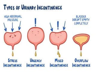 Stress Urinary Incontinence (SUI) : Dr Sharda Jain | PPTX