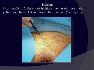 Vaginal approach for Stress Urinary Incontinence surgery | PPTX
