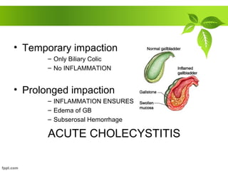• Temporary impaction
– Only Biliary Colic
– No INFLAMMATION
• Prolonged impaction
– INFLAMMATION ENSURES
– Edema of GB
– Subserosal Hemorrhage
ACUTE CHOLECYSTITIS
 