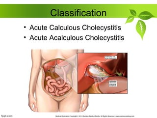 Classification
• Acute Calculous Cholecystitis
• Acute Acalculous Cholecystitis
 