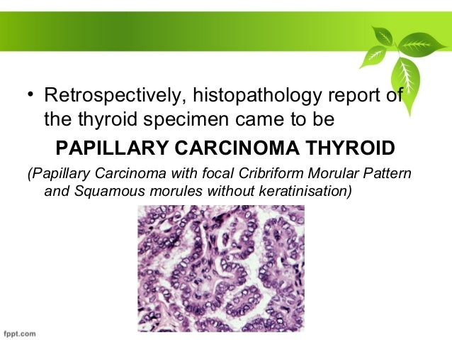 A case of papillary carcinoma thyroid with hematogenous spread