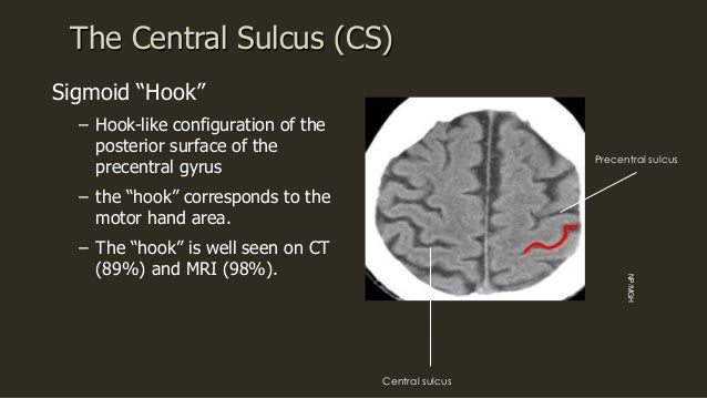 Sulcal anatomy supratentorial brain, excluding the temporal lobe.
